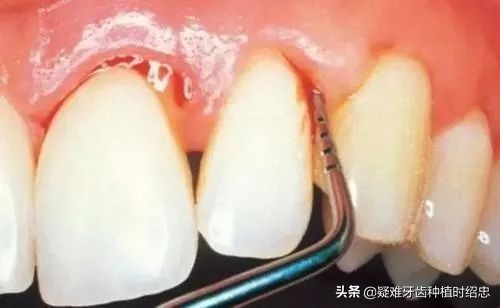 为什么换完牙齿后牙齿还会松动,换过的牙齿松动是什么原因