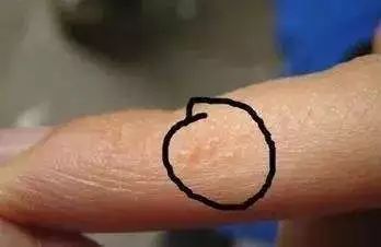 脚臭又脱皮，为什么脚气问题这么难解决？