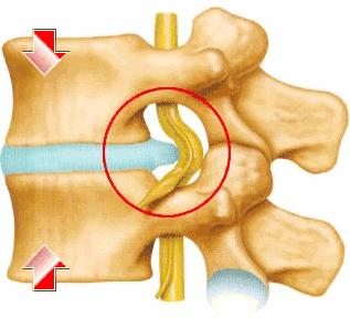 腰椎间盘膨出怎么治效果最好,腰椎间盘膨出有什么好的治疗方法