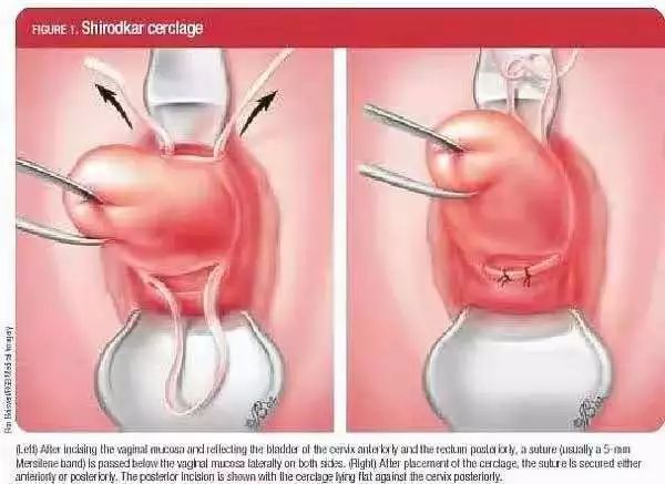孕期宫颈环扎是怎么做,宫颈机能不全做环扎成功率有多高