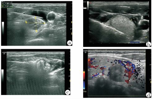 甲状腺结节三种诊断和处理方法,刚查过来的甲状腺结节怎么治疗