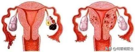 子宫内膜异位卵巢囊肿怎么消除,子宫内膜异位卵巢囊肿怎么手术
