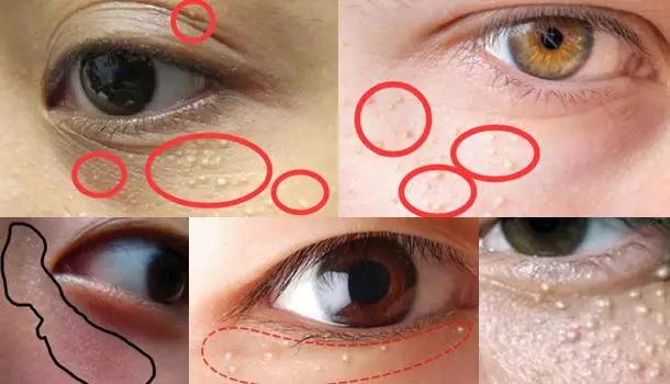 去眼纹去黑眼圈用什么方法,去眼袋眼纹公认最好用的土方法