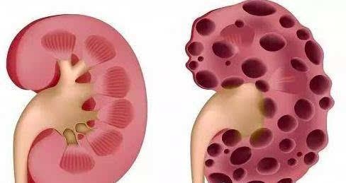 体检发现了肾囊肿，到底该怎么办？