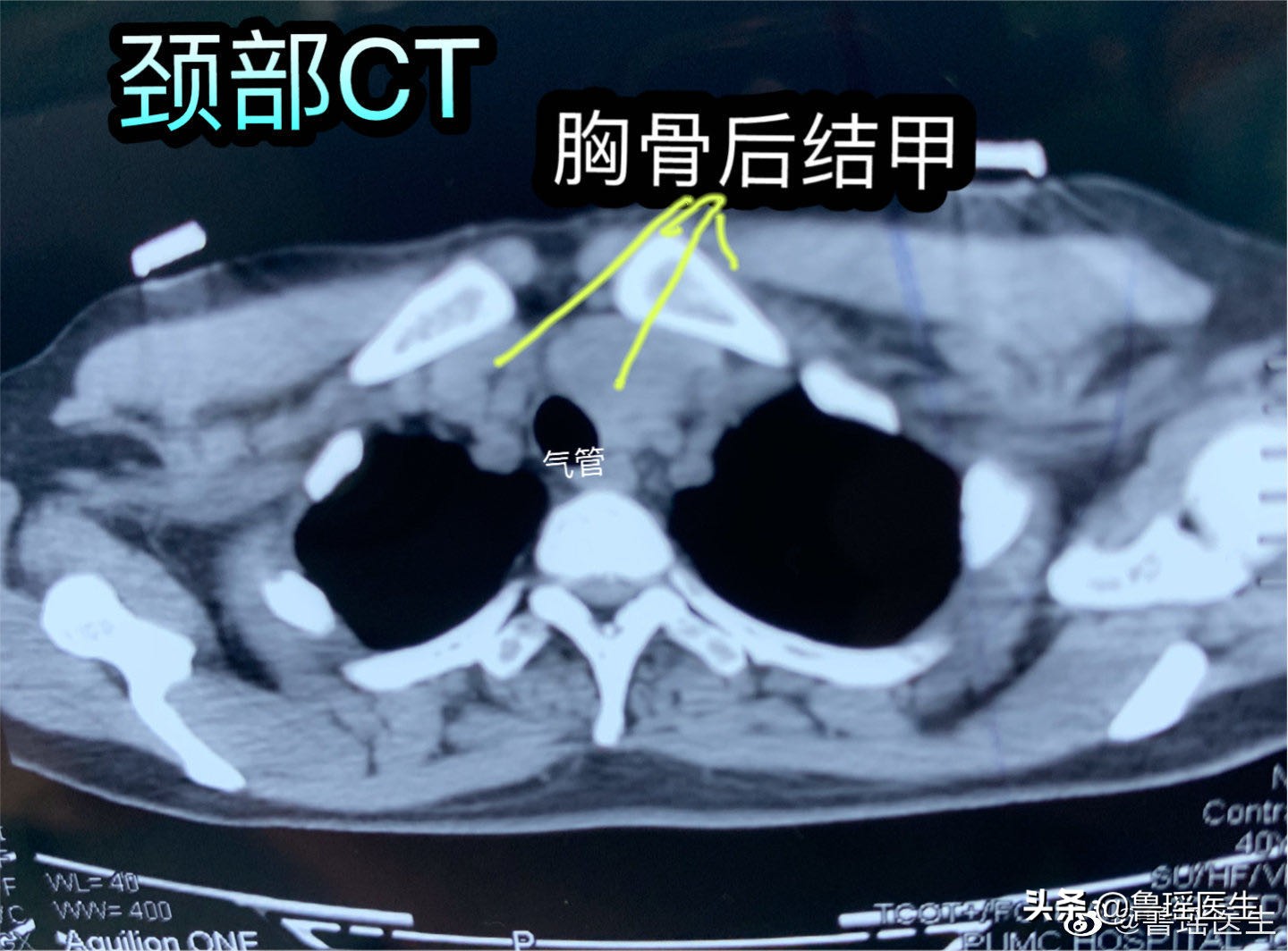 甲状腺结节靠近气管一定要手术吗,甲状腺结节多大才会压迫气管