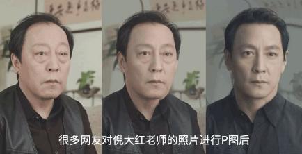 手术去眼袋安全吗,去眼袋手术多少钱