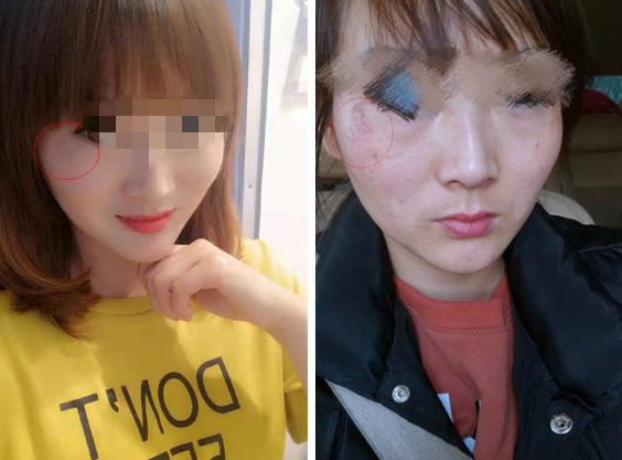 女子祛斑不成反“毁容”，斑美娜涉嫌虚假宣传、未经备案销售