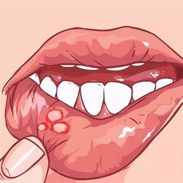 口腔溃疡反复发作吃什么中药调理,舌下口腔溃疡中医如何辨证