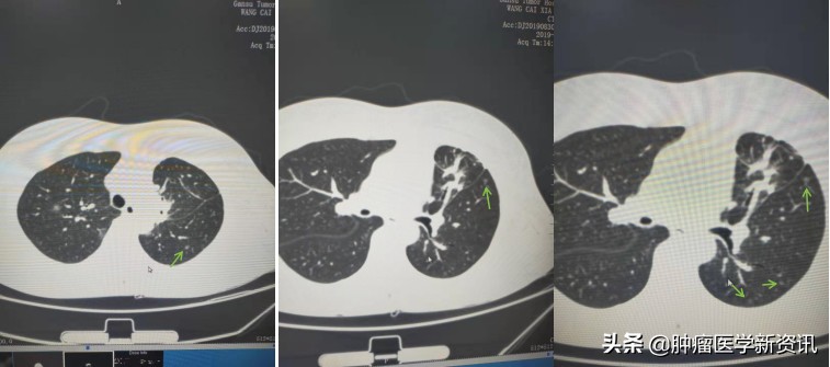 抗癌物质能治愈癌症吗,抗癌成功的几率有多大