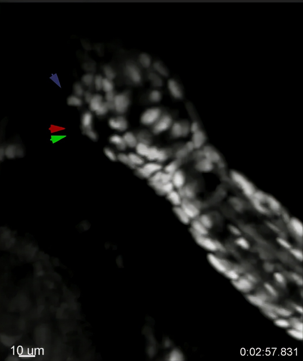 秃头是因为毛囊坏死吗,毛囊干细胞治疗秃头