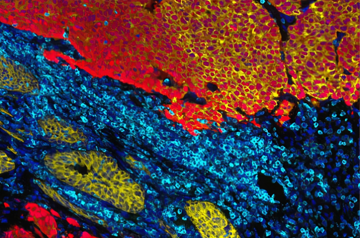 密歇根大学癌症研究,国际上前列腺癌的最新研究成果