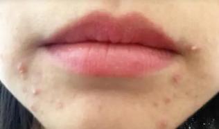 中医教你如何降胃火最简单,吃辣的胃火很大中医怎样解决