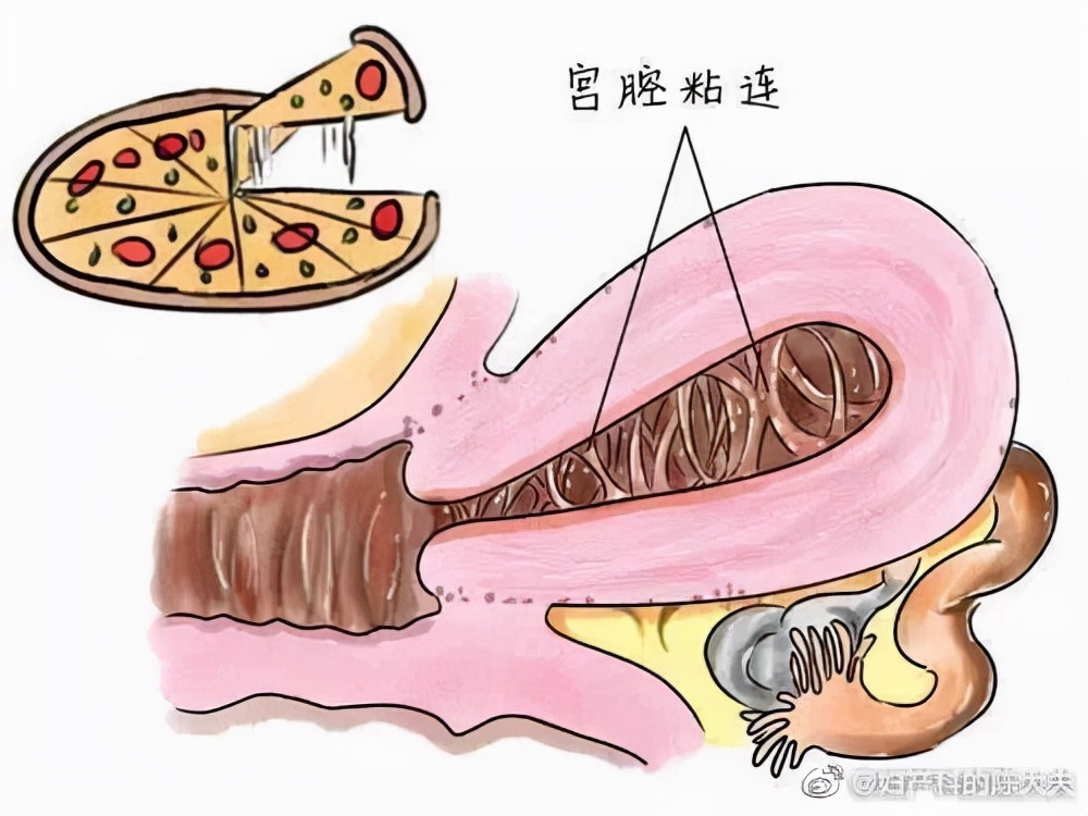 流产对子宫内膜厚度的影响,流产对女人伤害最大是哪里