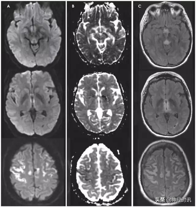 脑卒中的快速识别ppt,脑卒中神经影像学实例解析