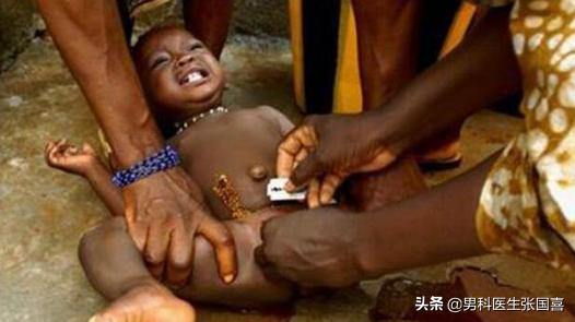 在中间剌一圈，居然还有这种割包皮的手术方法？