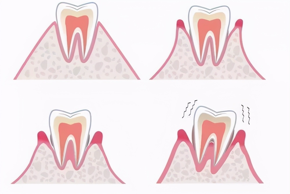300洗牙贵吗,洗牙300和600元有什么区别