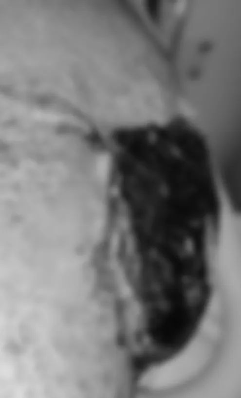 男士膝盖破了怎么办,膝关节破了个洞