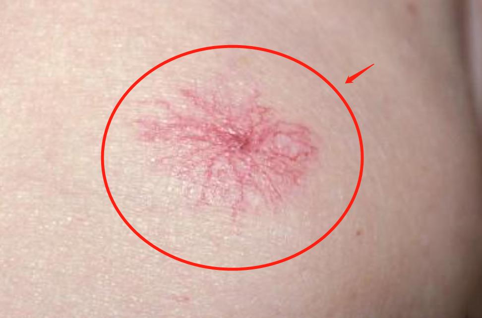 皮肤上长红痣要当心是肝病的征兆,身上长了几个细细的红痣是肝病吗