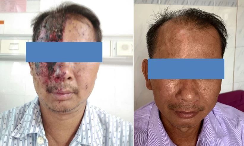 面部疱疹病毒症状,脸上疱疹病毒引起头刺痛