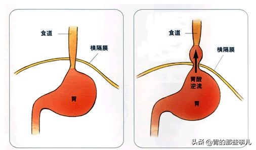 反流性咽喉炎怎么判断出来,反流性咽喉炎为什么感觉不到反酸