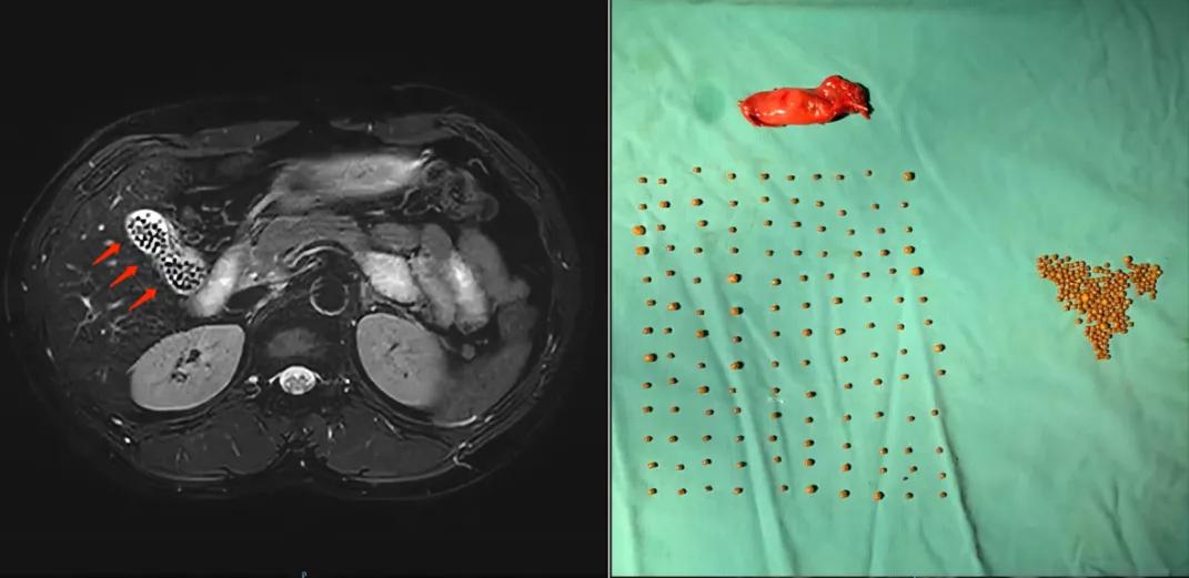 到底是保胆好还是切除好,怎么手术保胆