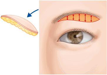 当你老了，上眼皮松了，其实恢复年轻并不难...