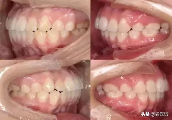 戴牙套2年不戴保持器反弹案例,戴牙套成功案例不戴保持器