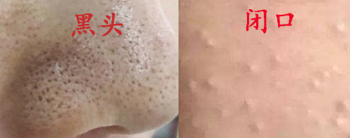 脸上痘痘一直反反复复怎么回事,脸上痘痘一直反复长痘印消不下去
