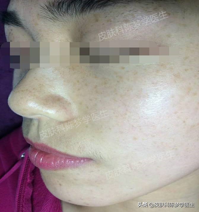 如何治疗脸上褐青色痣样斑,什么是褐青痣斑