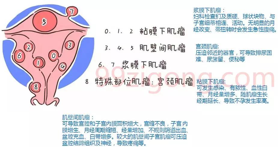 子宫肌瘤开腹手术是大手术吗,子宫肌瘤手术大概需要多少钱