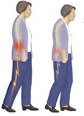 腰椎管狭窄有什么症状怎么样治疗,腰椎管狭窄是怎么引起的如何治疗