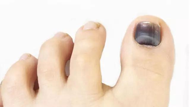 跑步后脚趾甲充血变黑怎么办,跑步为什么有黑指甲