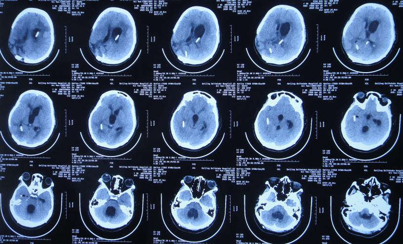 脑室有粘连脑积水有什么办法,脑动脉畸形手术后出现急性脑积水