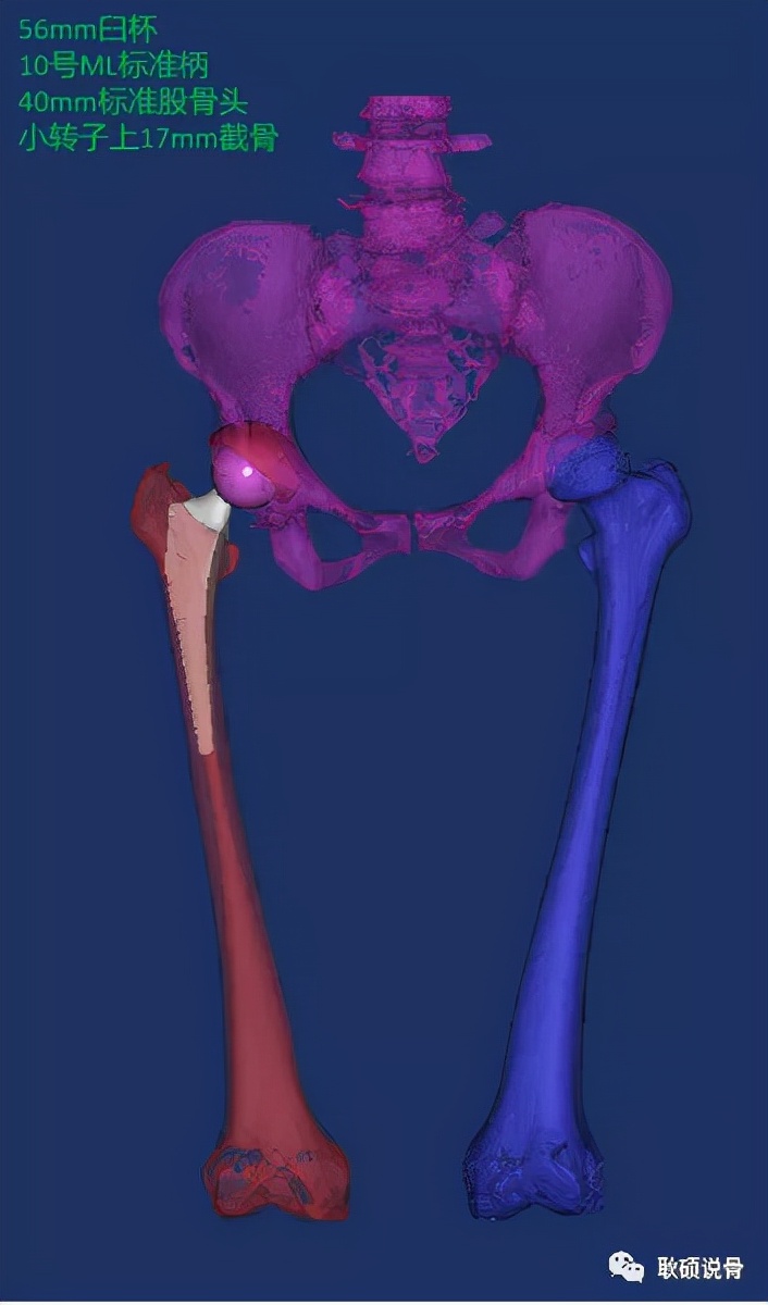 股骨头置换术后切口愈合,股骨头坏死置换第二次手术全过程