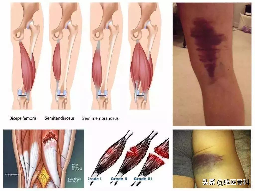 肌肉拉伤康复治疗最快最好方法,肌肉拉伤怎么做才能恢复更快