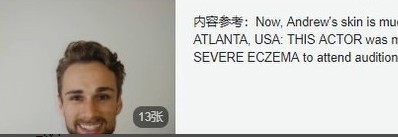 头条功能实验室：美国演员安德鲁湿疹和皮癣用这个食疗得到改善