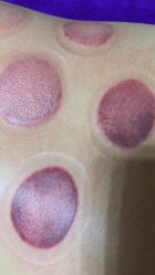 拔罐好吗对身体有伤害吗,拔罐好不好图片