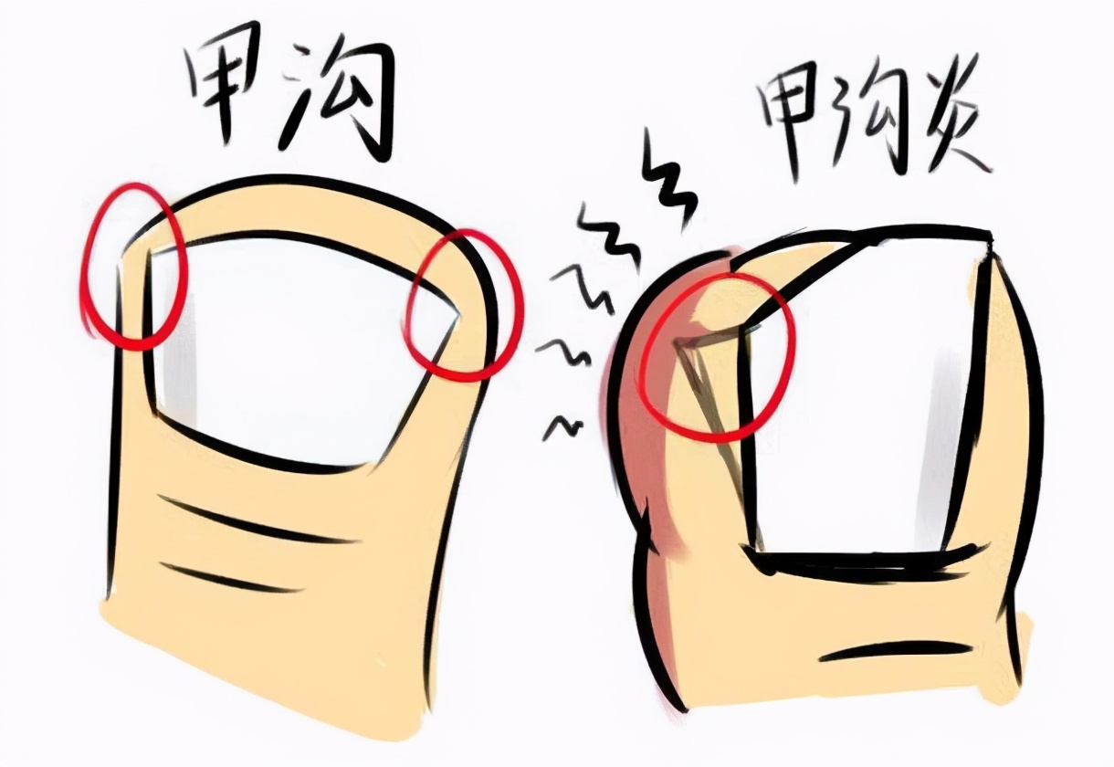 甲沟炎好治吗是什么原因引起的,甲沟炎特别严重的情况下怎么办