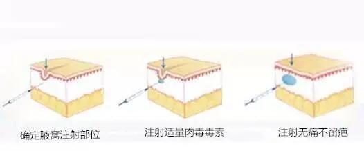 夏天来了腋臭如何解决,夏天来了狐臭又加重了该怎么办