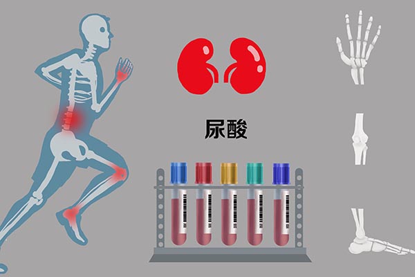 自查痛风的方法,查尿酸前一晚注意事项