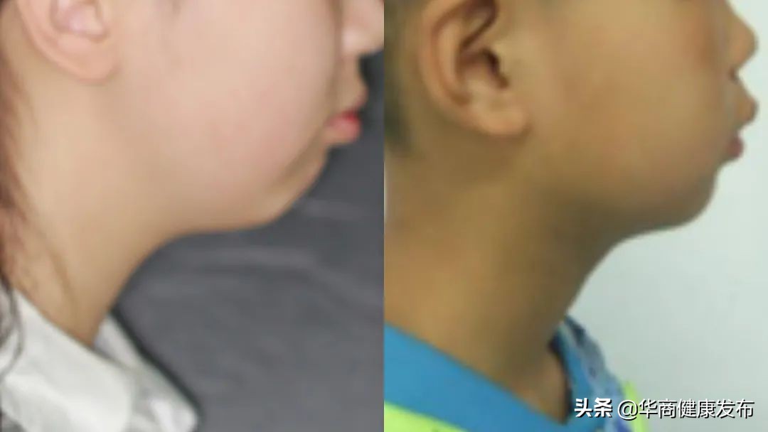 牙齿错颌畸形矫正的最佳年龄,30岁了错颌畸形如何矫正