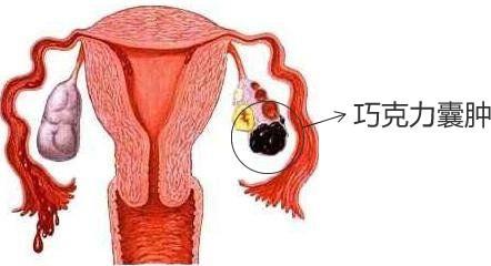 8个好习惯让你远离卵巢疾病，永葆女性健康年轻