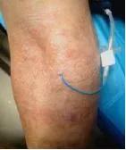 地塞米松新用途：轻松搞定医用胶粘剂相关性皮炎