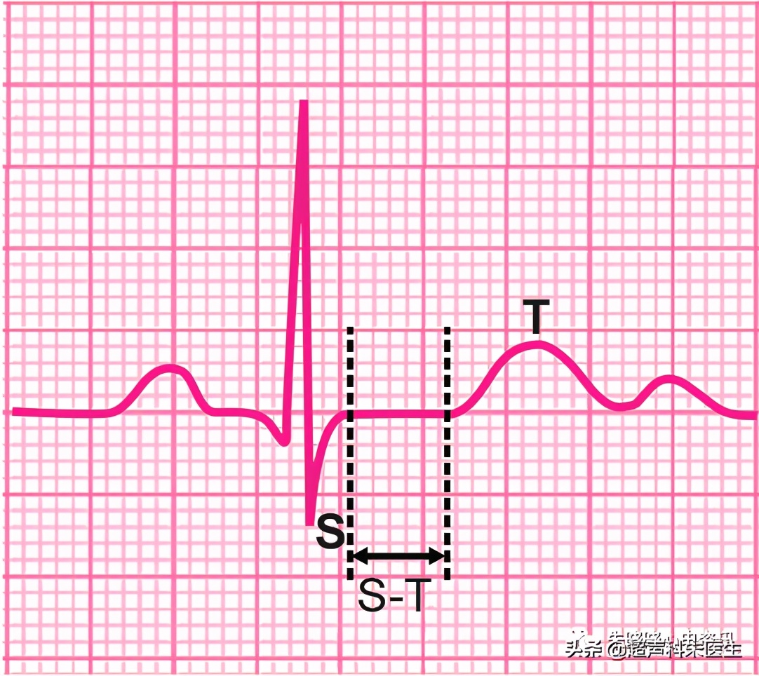 t波倒置诊断,t波倒置如何区分严重程度