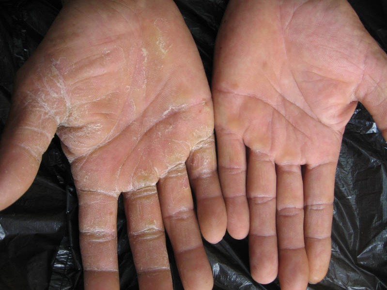 手脚湿疹和癣的区别,手足癣干裂脱皮怎么治