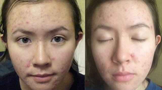 自然乐园芦荟胶可以祛痘吗,纯天然芦荟胶祛痘