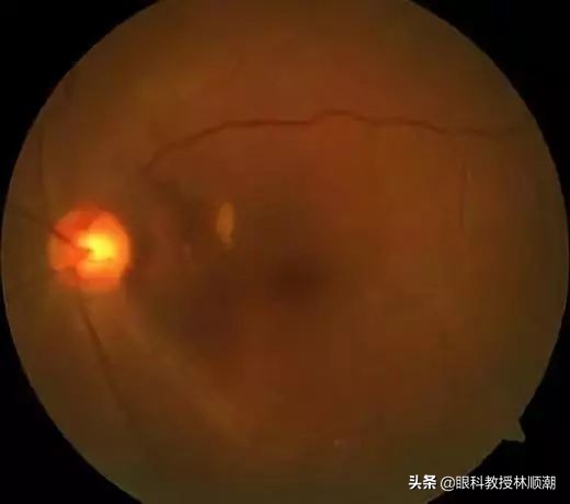 熬夜短时间眼底出血,眼底大出血失明