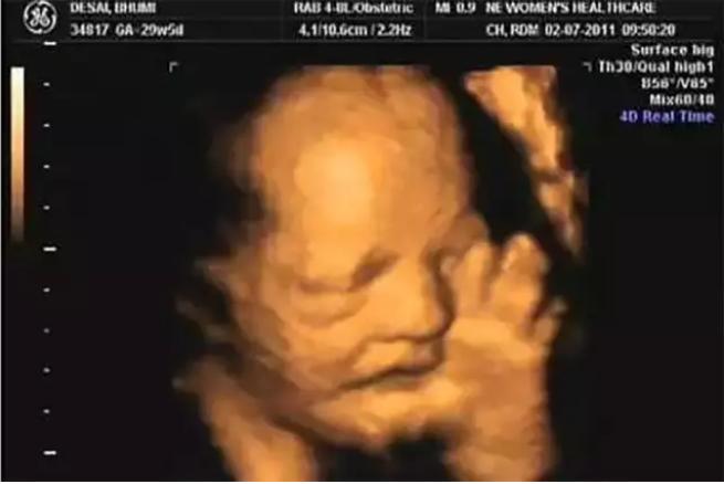 小孩儿嘬手指会导致什么,三个月宝宝一直嘬手指要不要干预