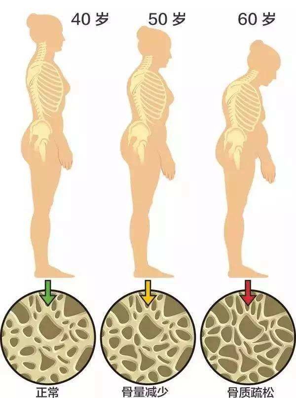 骨密度检查骨量减少如何改善,二十几岁骨量减少是什么原因