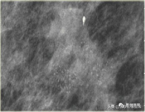 乳腺钙化怎么区分良性和恶性,乳腺钙化的诊断与分级